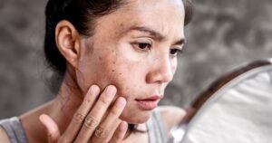 Melasma: quando a pele pede cuidado e paciência