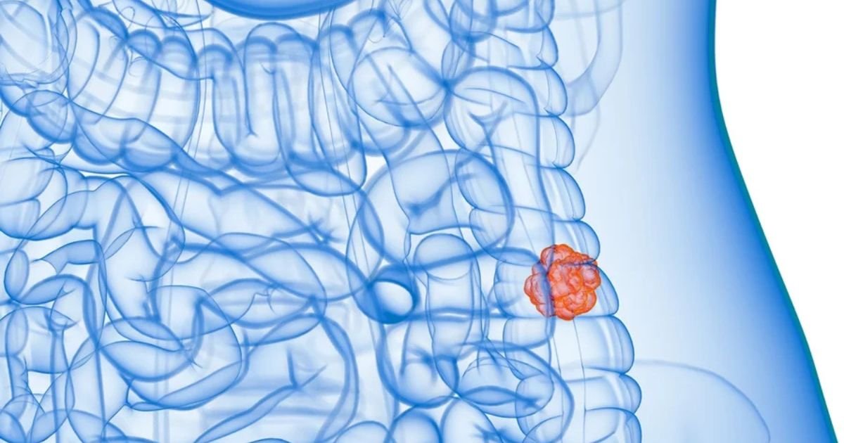 Transcriptômica Espacial: O “Google Maps” que está revolucionando o tratamento do câncer no Brasil