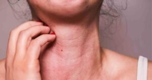 Massachusetts em alerta: Carrapato que causa alergia a carne se espalha pelo estado