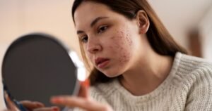Tratamentos para Estrias e Acne na Puberdade: Cuidados Delicados para a Pele em Transformação