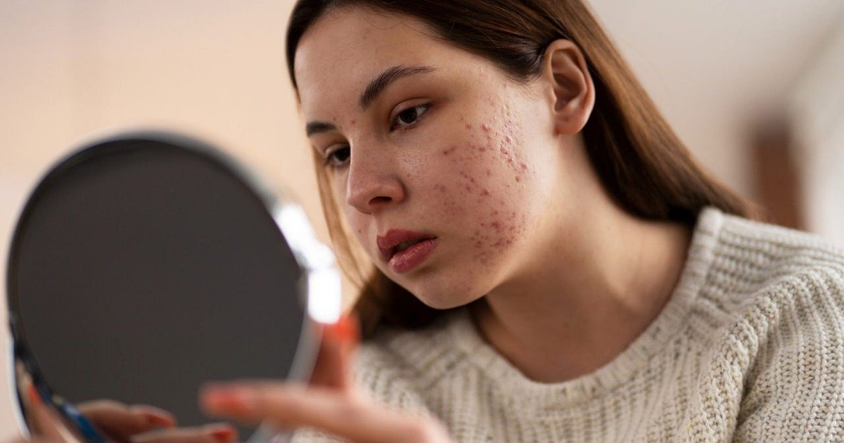 Tratamentos para Estrias e Acne na Puberdade: Cuidados Delicados para a Pele em Transformação