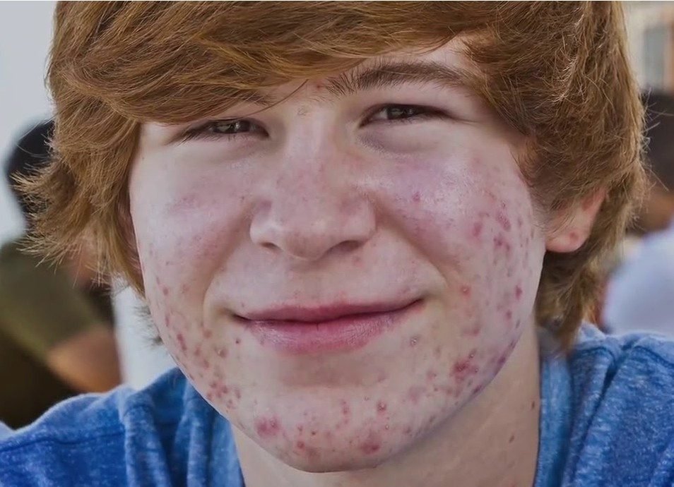 Adolescente com acne nas bochechas e no queixo