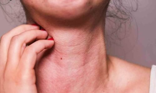 Massachusetts em alerta: Carrapato que causa alergia a carne se espalha pelo estado