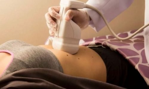 Tecnologia Lipossonix cresce em Massachusetts como alternativa não invasiva para gordura localizada