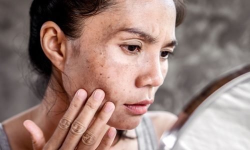 Melasma: quando a pele pede cuidado e paciência