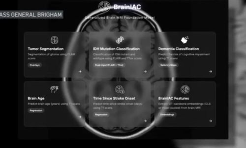 BrainIAC: Nova IA desenvolvida em Massachusetts pode prever demência antes dos primeiros sintomas