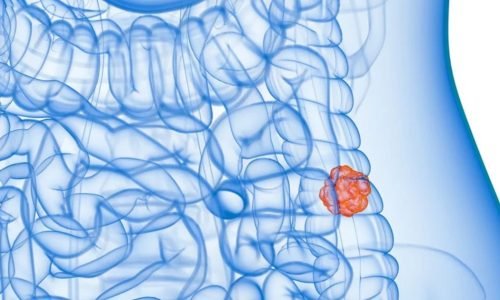 Transcriptômica Espacial: O “Google Maps” que está revolucionando o tratamento do câncer no Brasil