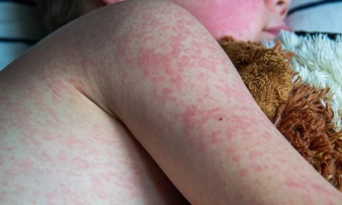 Saúde em Alerta: Massachusetts confirma dois casos de sarampo e autoridades reforçam vigilância